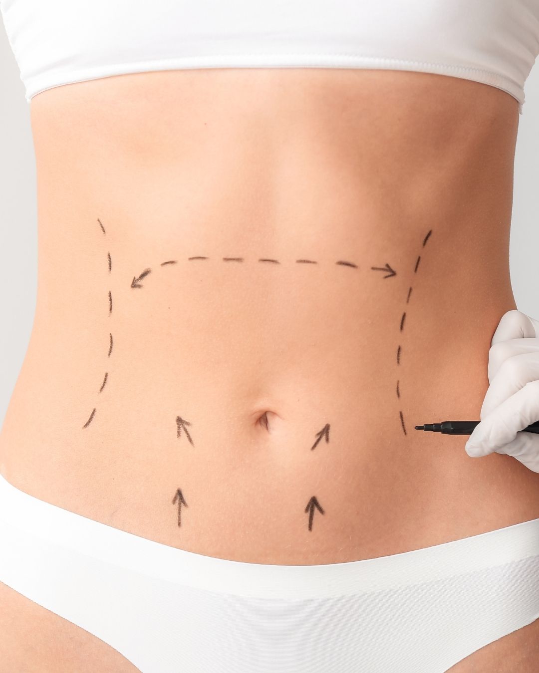 Abdominoplastia